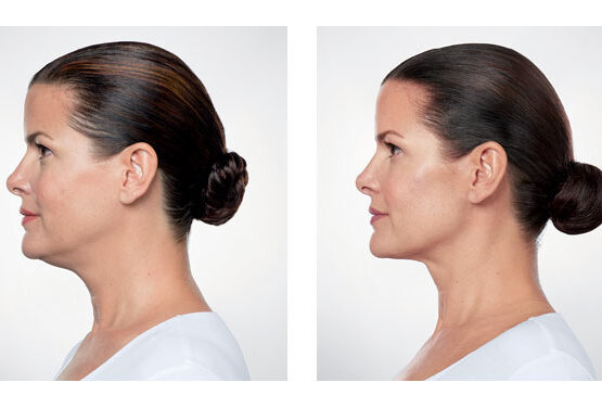 Kybella double chin treatment service