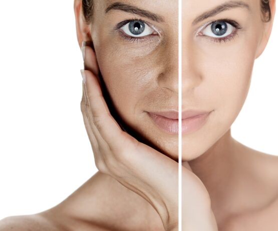 Microneedling and PRP face treatment